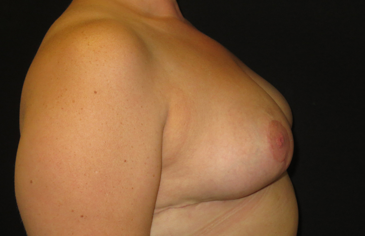 Breast reduction photo