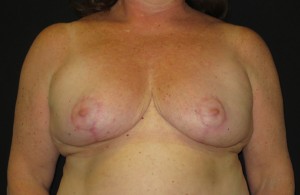 after breast reduction surgery photo