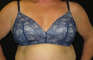 breast reduction bra