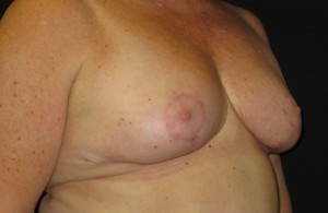 Breast reduction surgery after photo