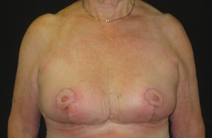 Breast surgery after photo