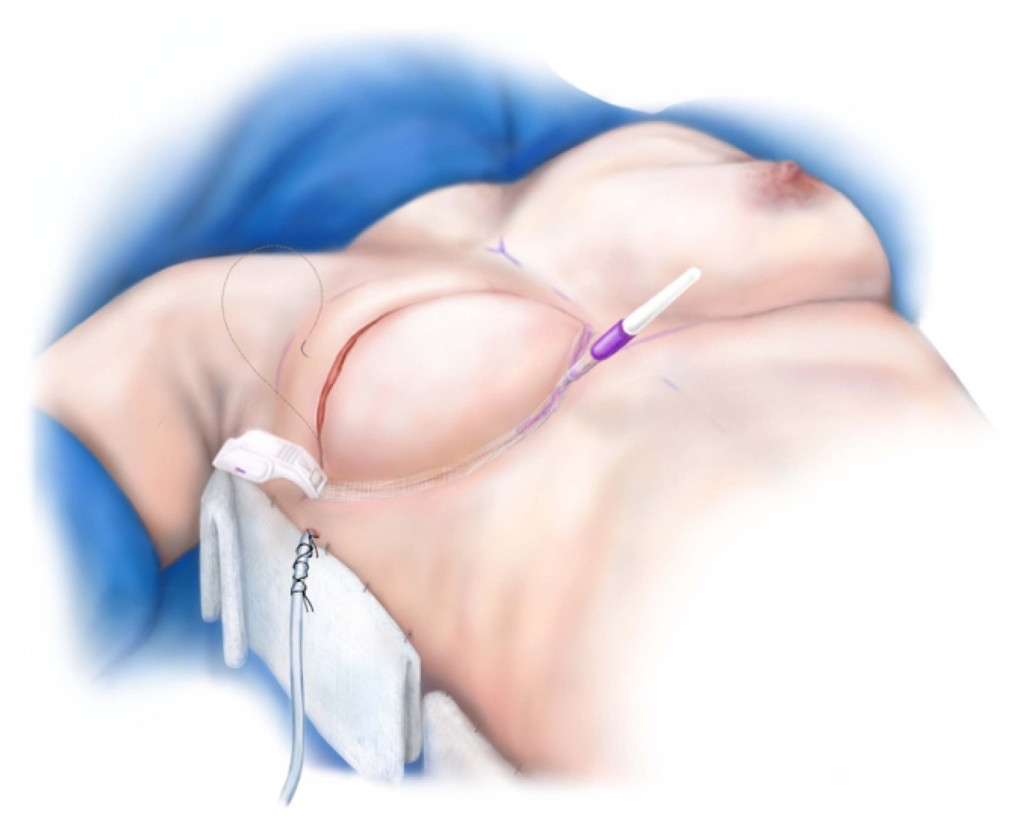 Reconstruction of the breast after mastectomy using abdominal tissue (known as DIEP or MS-TRAM) is the ‘Gold Standard’ in breast reconstruction.